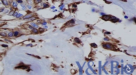 肿瘤-Vimentin-2-1_副本.jpg 肿瘤-Vimentin-2-1_副本.jpg